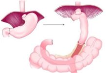 Au trecut 4 ani – Gastrectomie Gastrectomie Totala