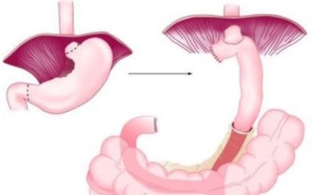 Dupa 6 – Gastrectomie Gastrectomie Totala